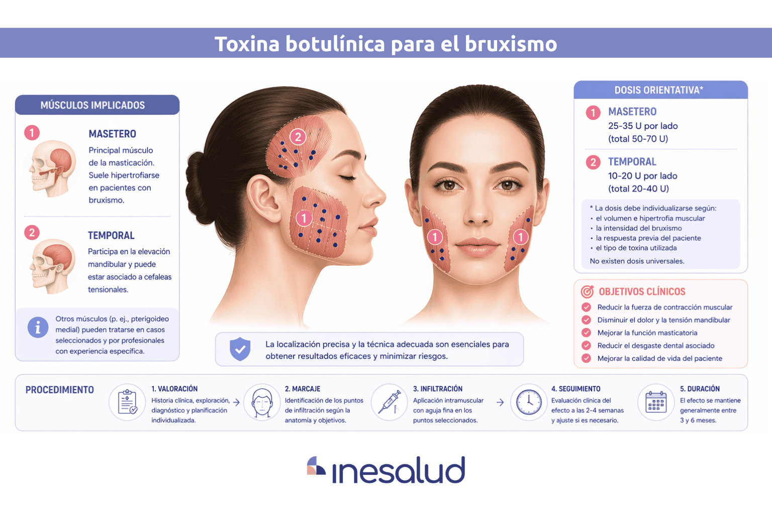 zonas de aplicación del bótox en bruxismo