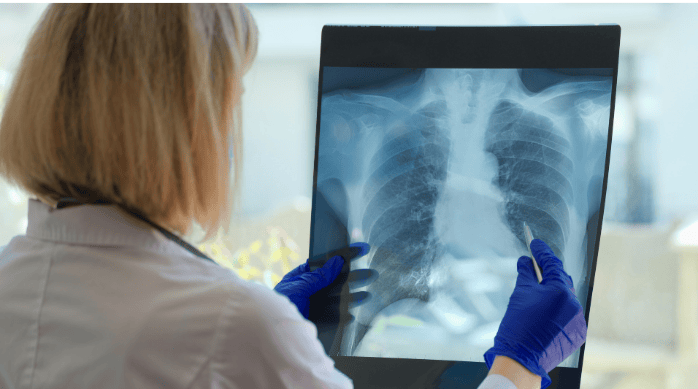 Cuántos segmentos pulmonares hay