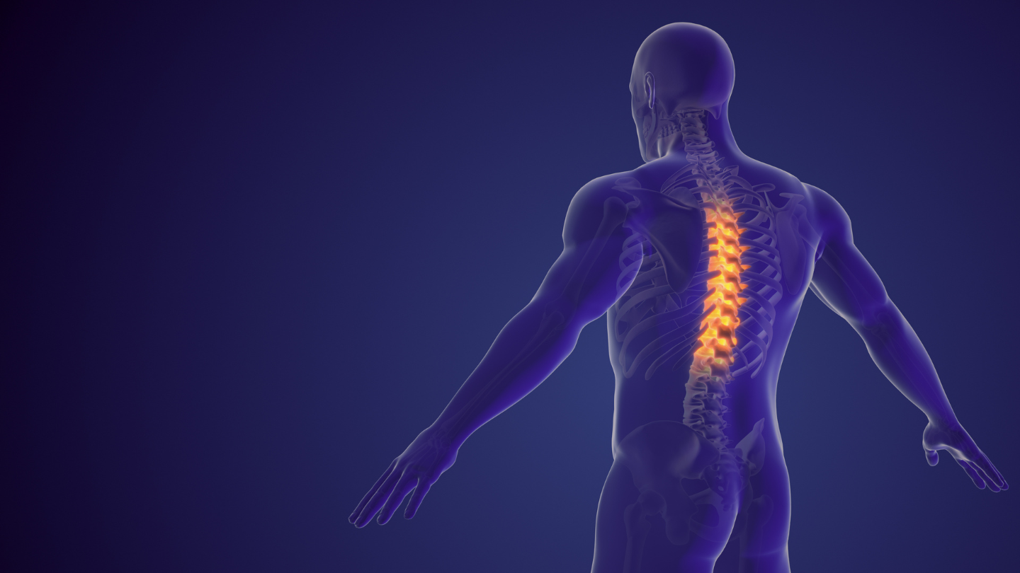 Lordosis