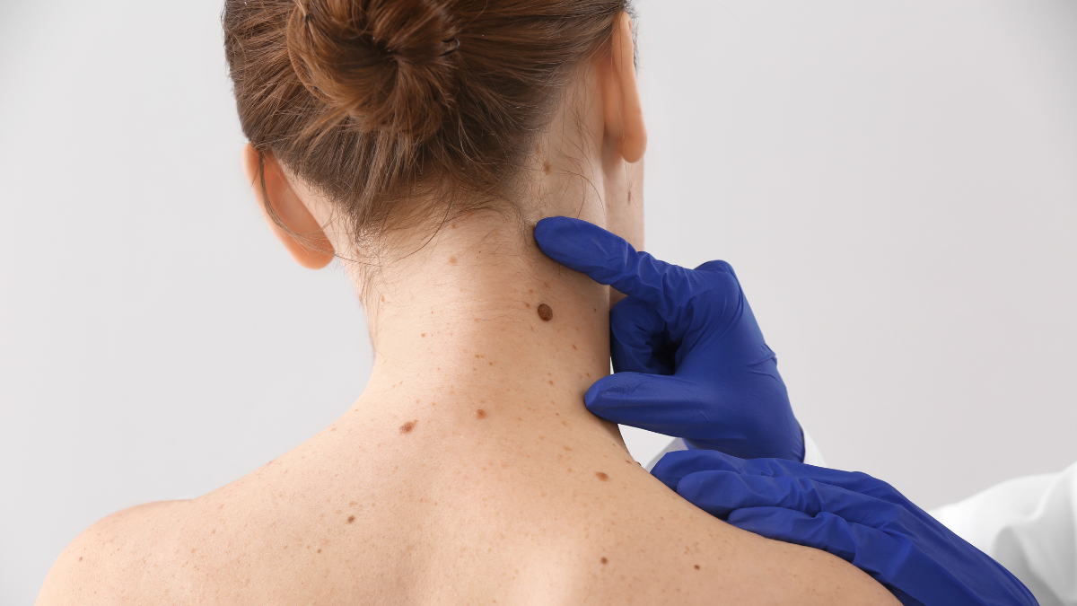 Nevus