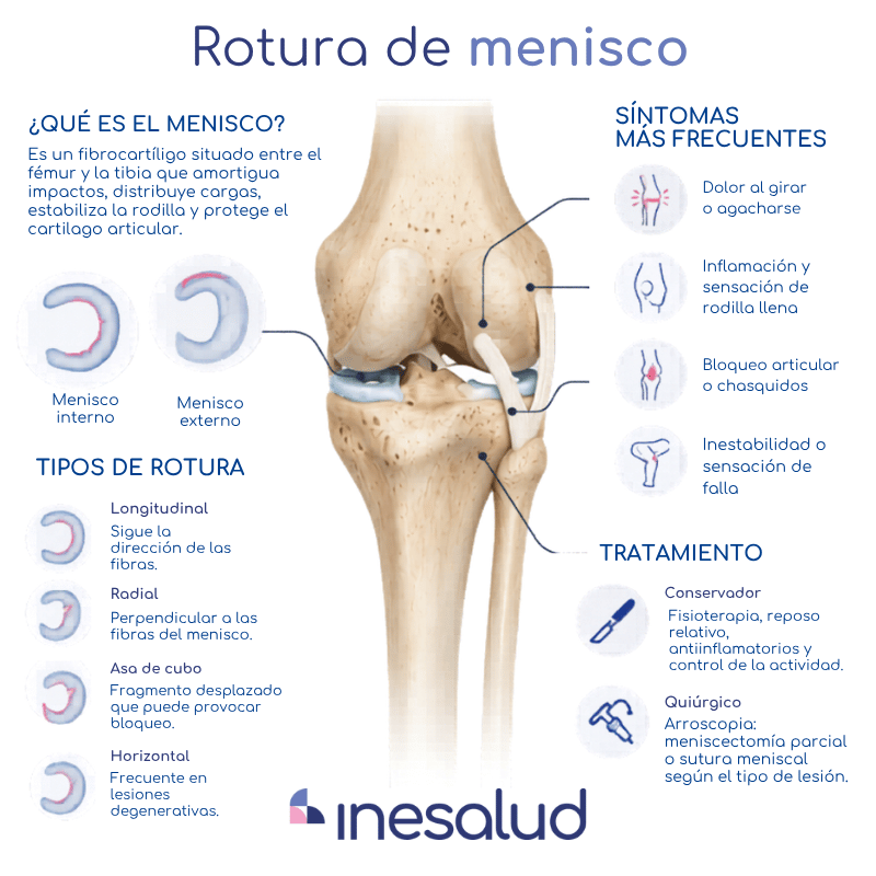 rotura de menisco