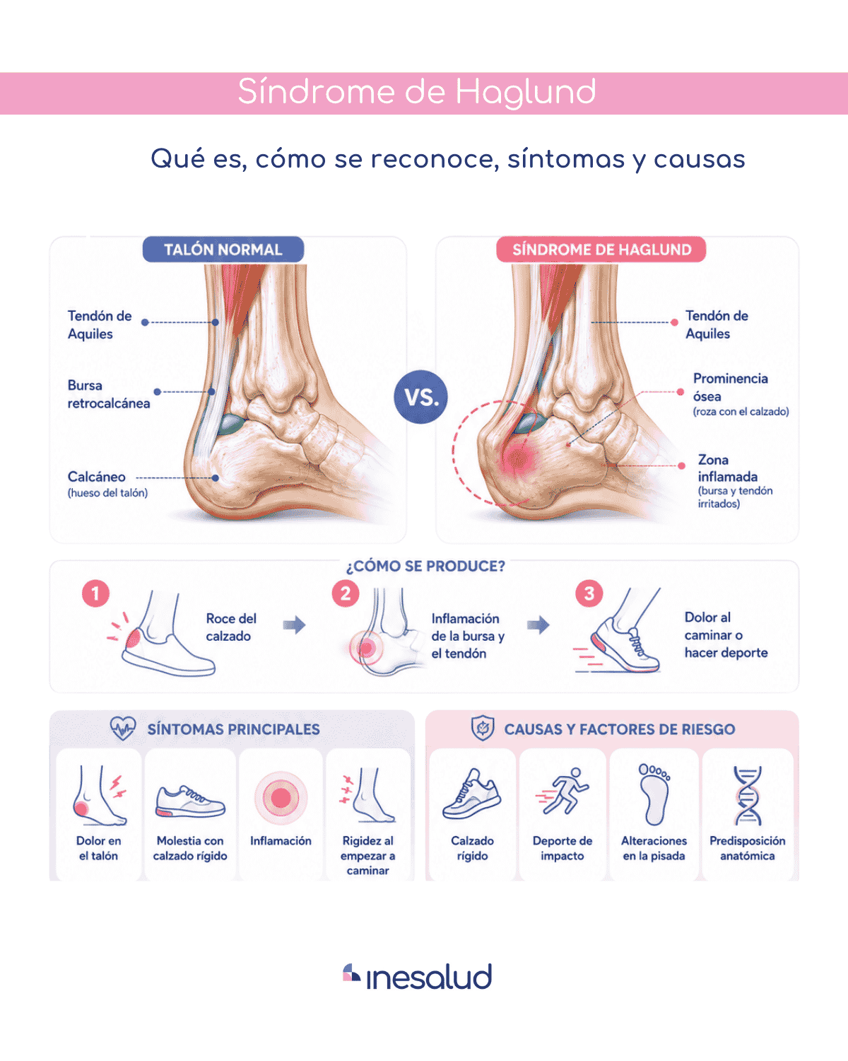 Infografía sobre qué es el síndrome de Haglund, cómo se reconoce, síntomas y causas