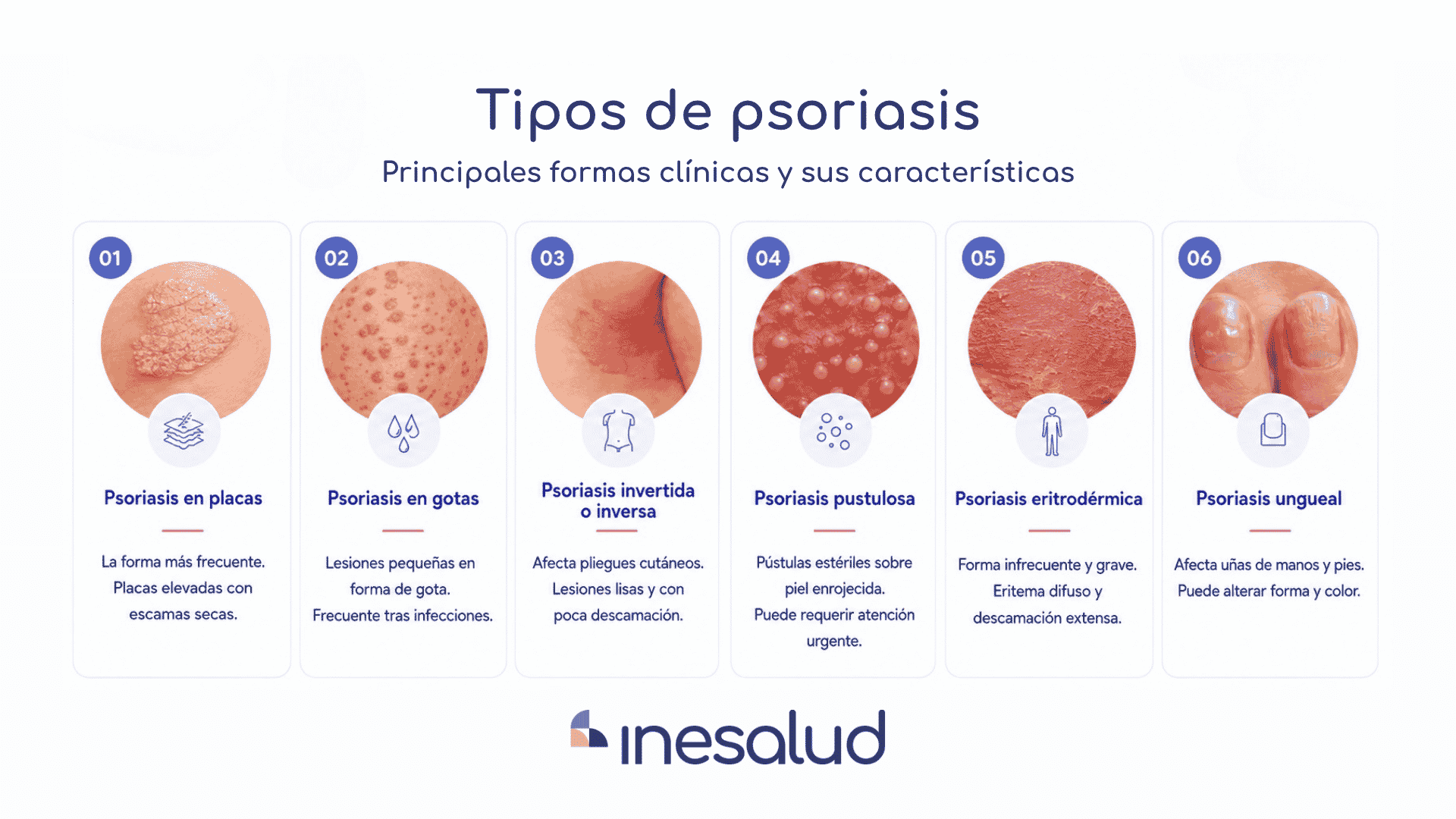 tipos de psoriasis
