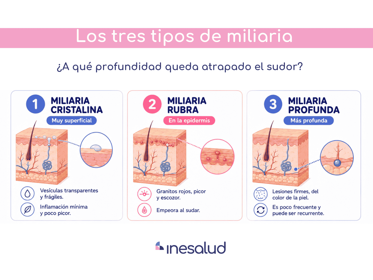 tipos de miliaria