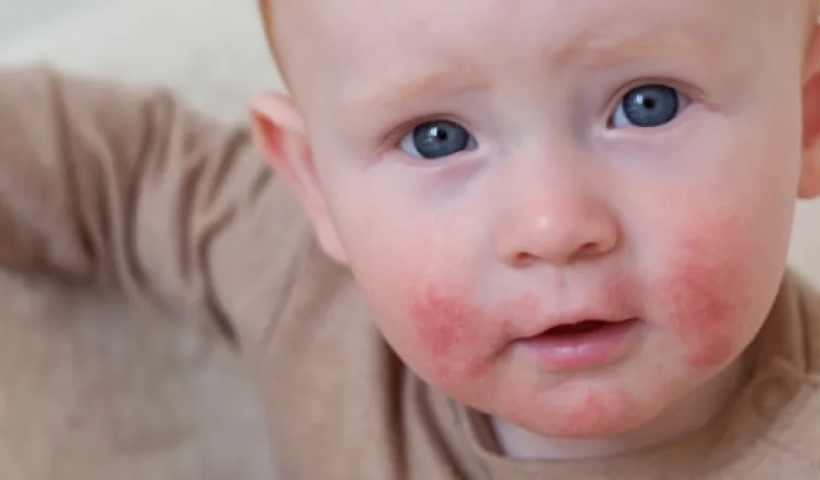 dermatitis atópica en niños