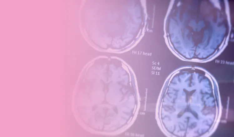 Tratamiento experimental alzheimer